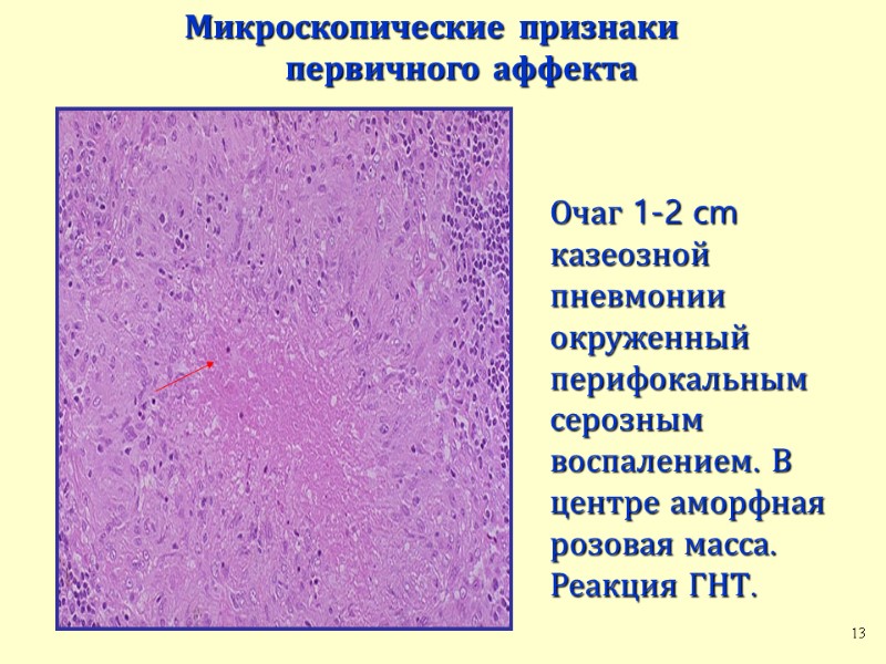 Очаг 1-2 cm казеозной пневмонии окруженный перифокальным серозным воспалением. В центре аморфная розовая масса.